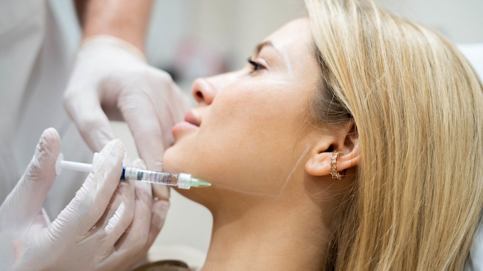 Jawline Filler
