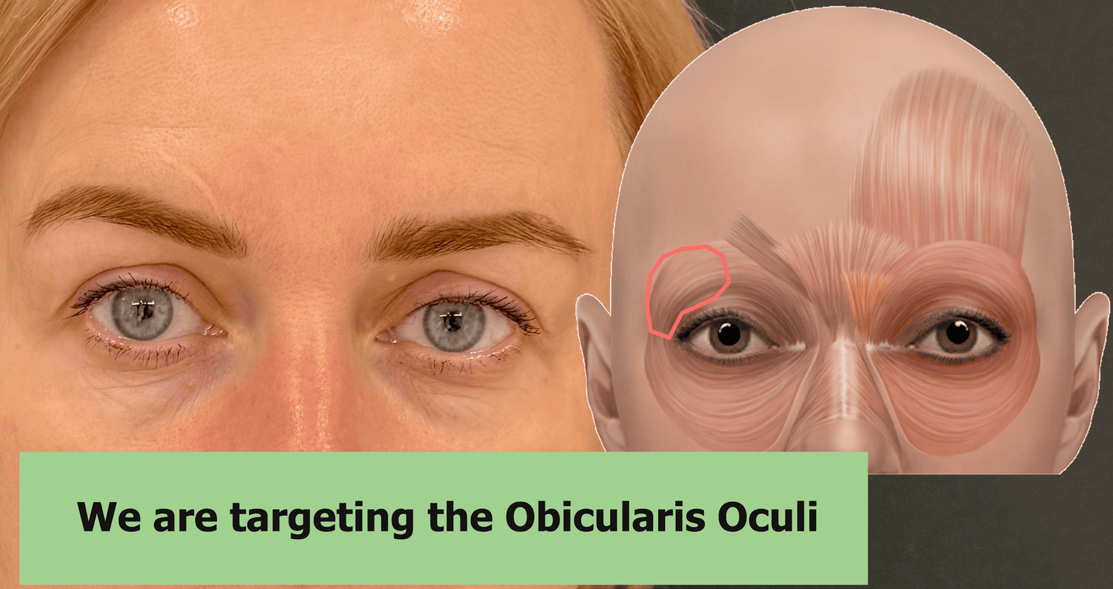 Before considerations for brow lift botox – mapping and symmetry