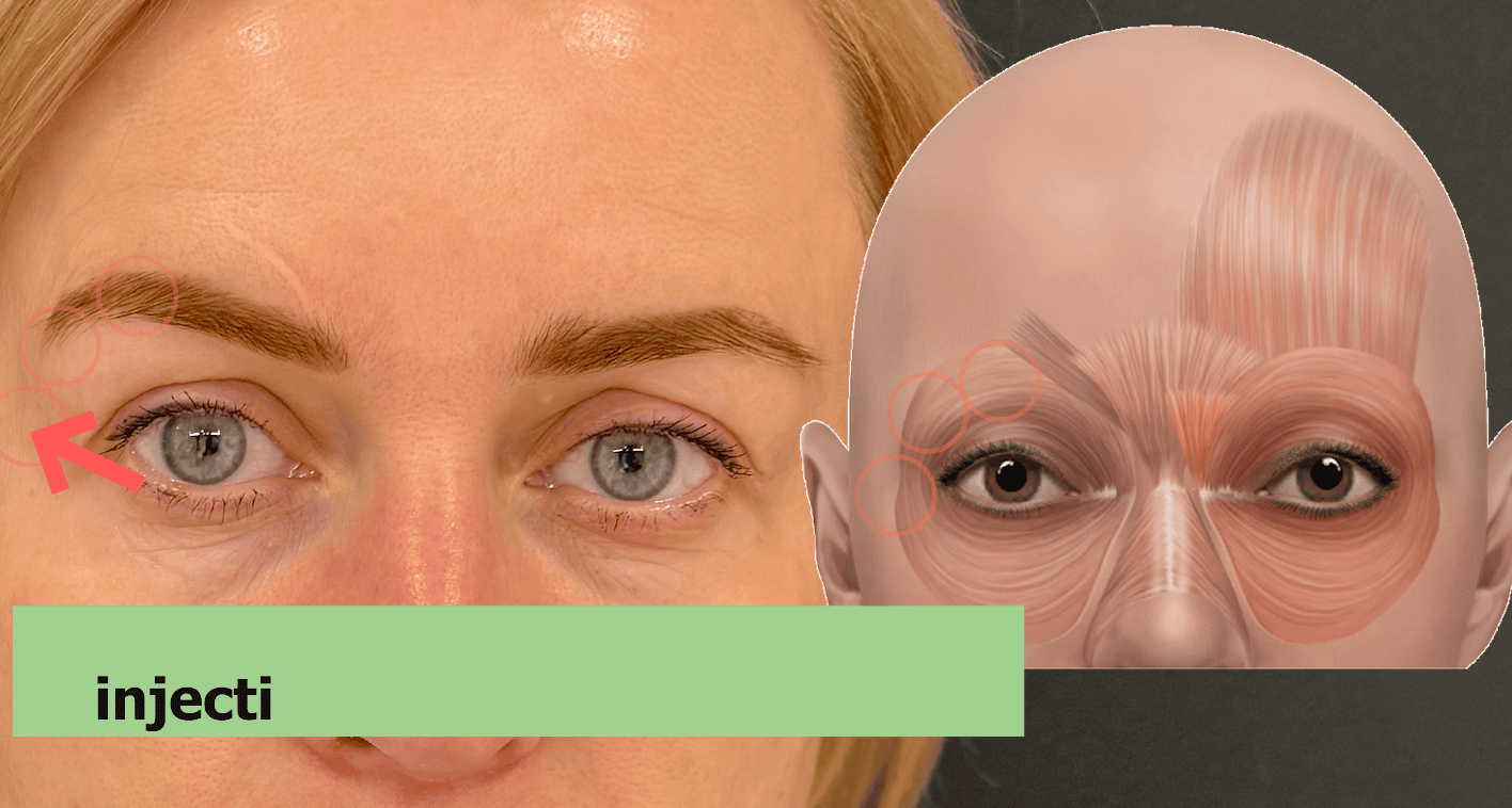Anatomy map for brow lift botox – elevators and depressors