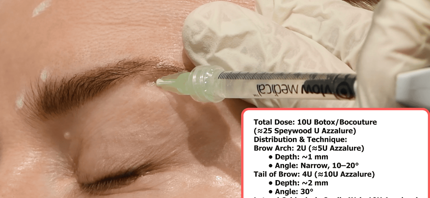 Brow lift Botox overview – balance of elevators and depressors in the upper face