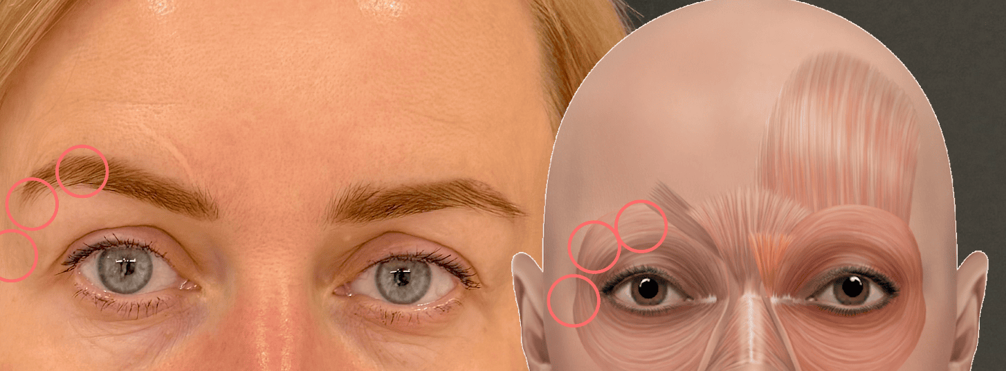 Botox Lift Botox