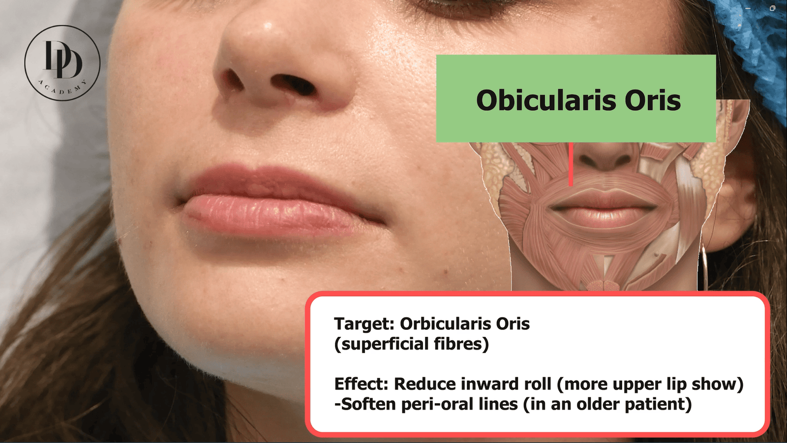 Botox lip flip injection points upper lip aesthetic training guide