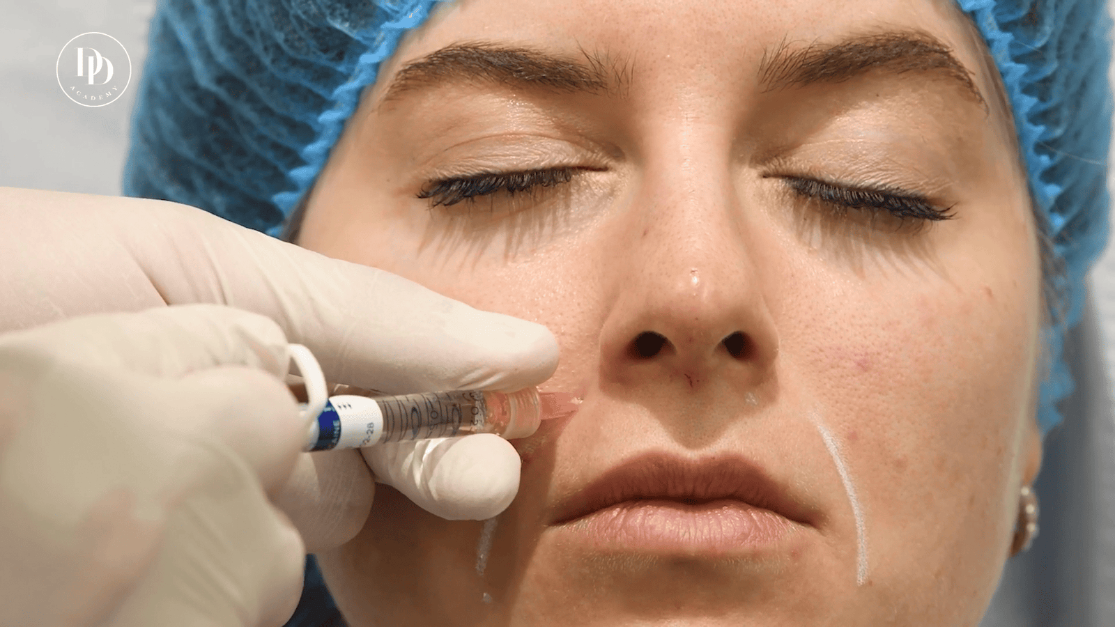 deep piriform space filler injection anatomy nasolabial fold support