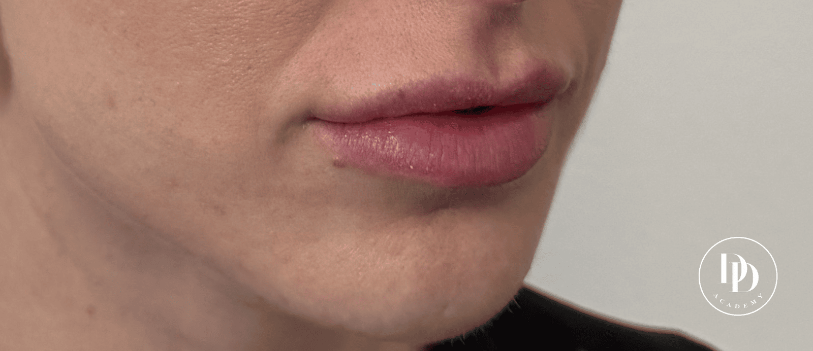 Masseter and platysma botox injection risk areas anatomy