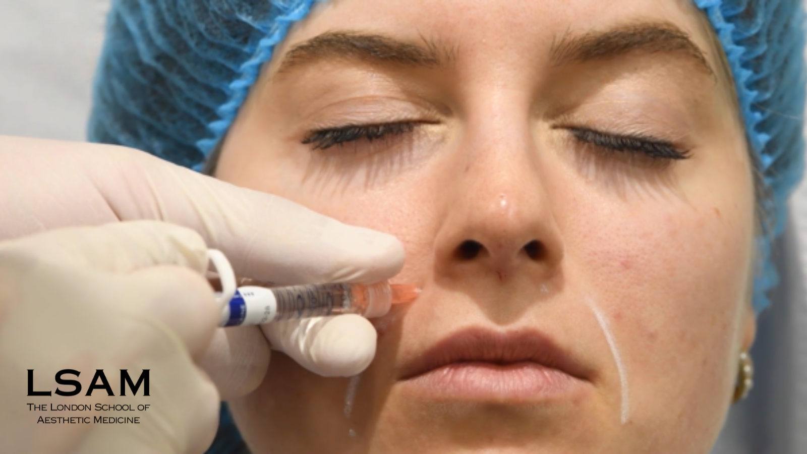 deep piriform space filler injection anatomy nasolabial fold support