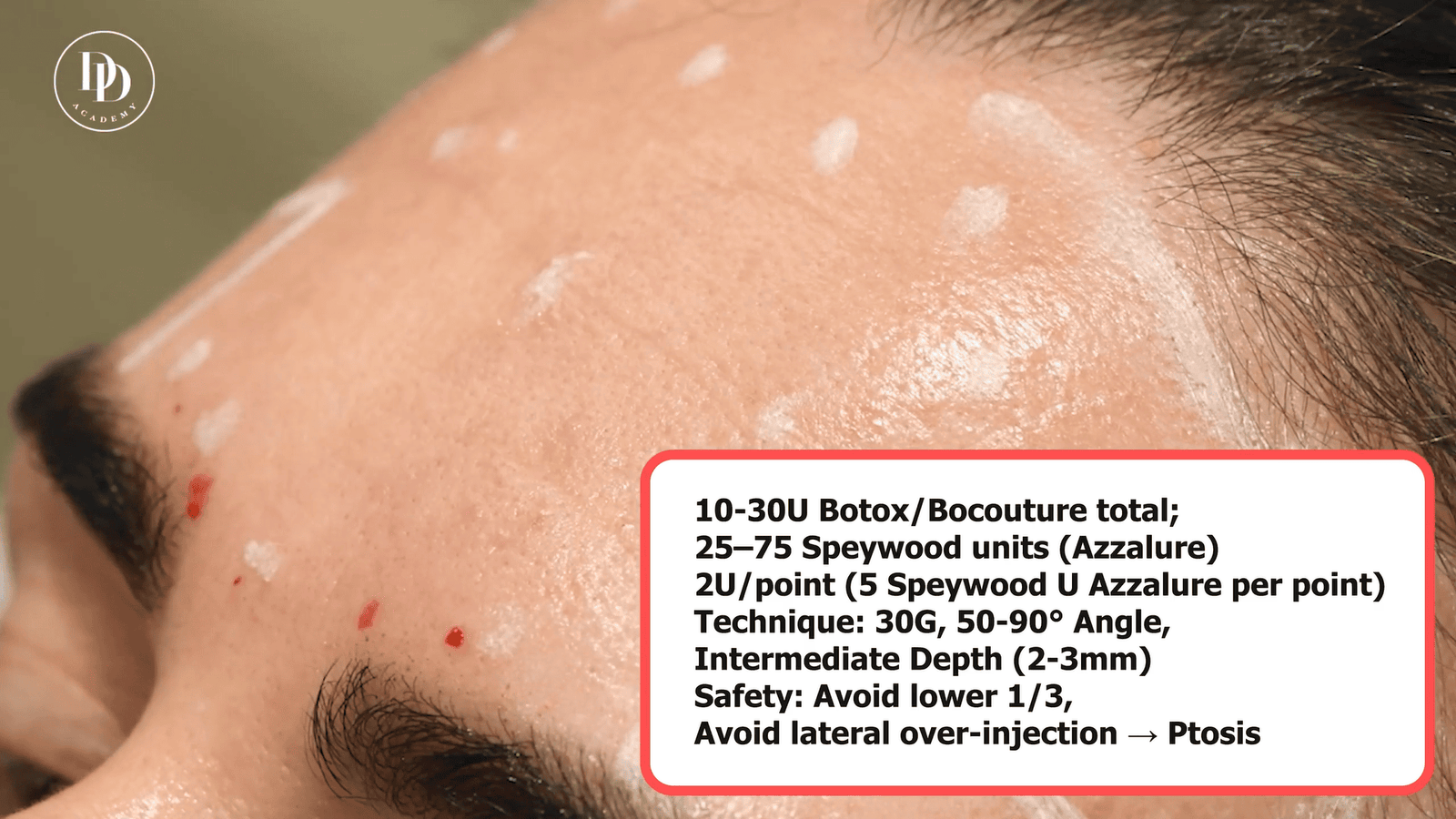 Aesthetic practitioner assessing patient for Bocouture or Azzalure treatment