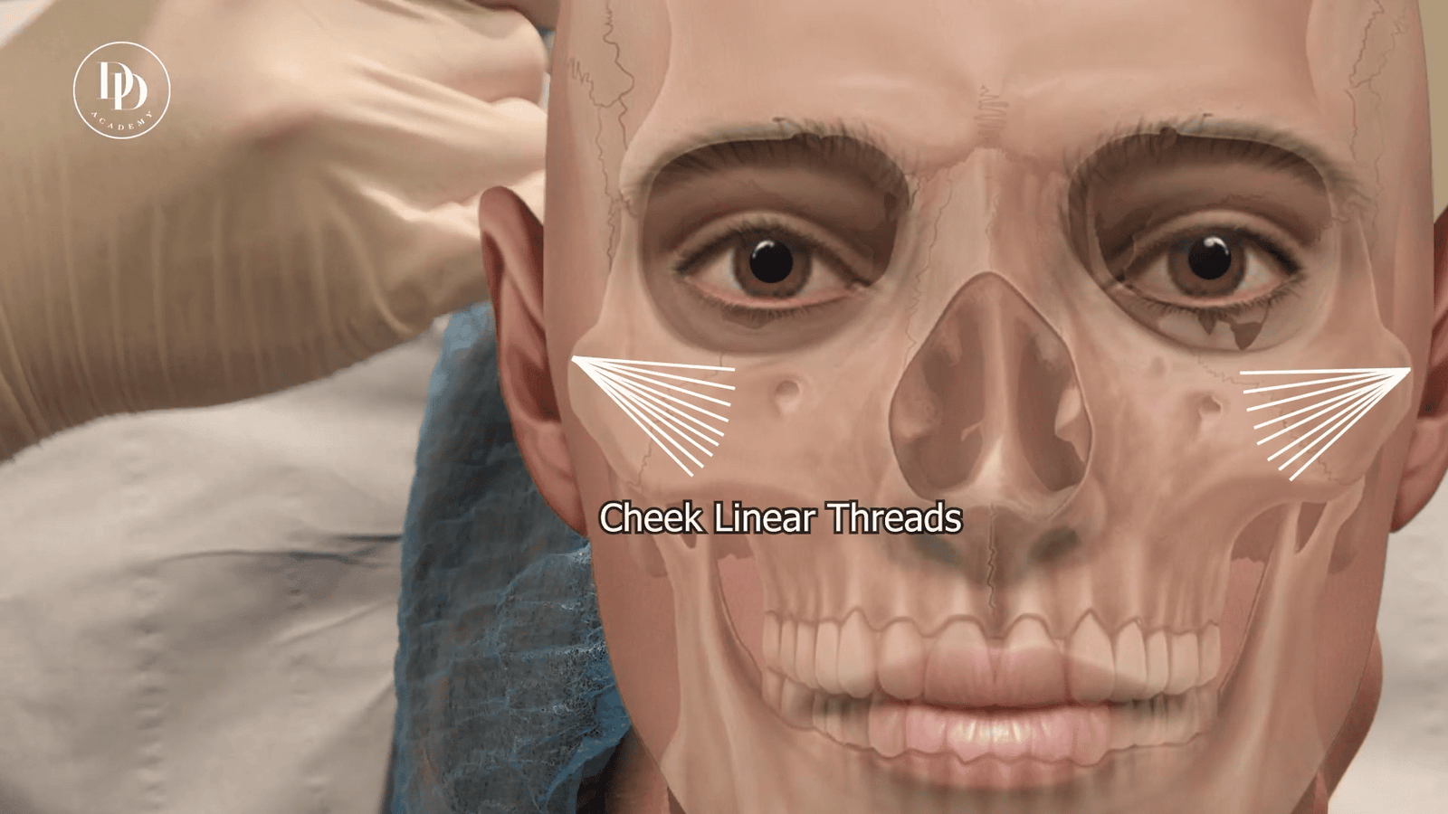 Cheek filler marking anatomical zones mapped on mid-face prior to injection