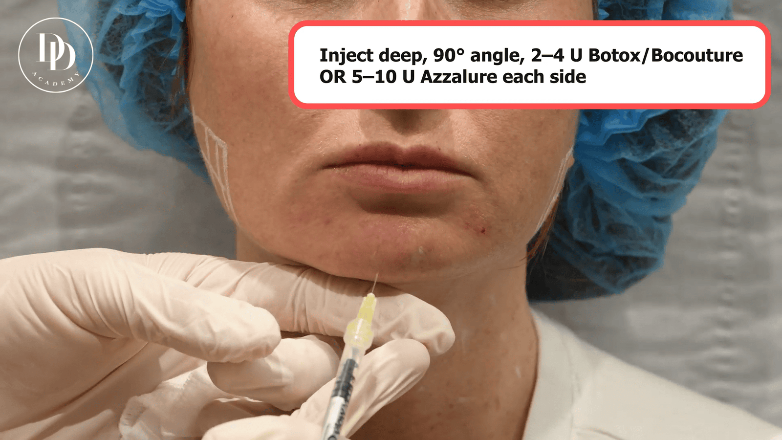 chin botox dosing and lower face anatomy highlighting safe injection points and mental foramen location