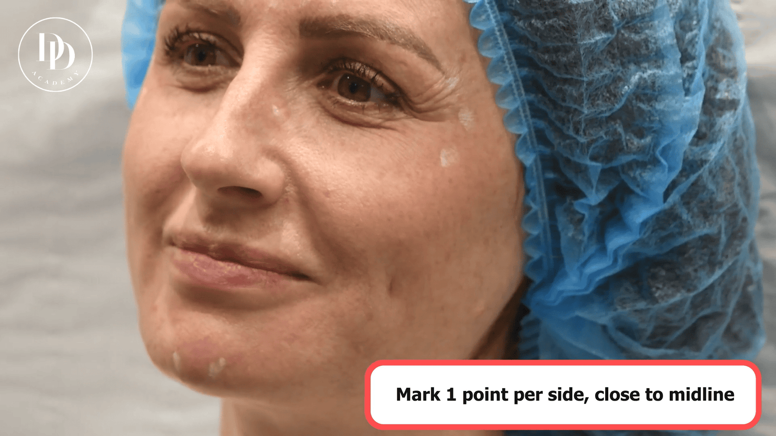 chin botox injection points mentalis muscle mapping diagram showing 2-point and 4-point techniques