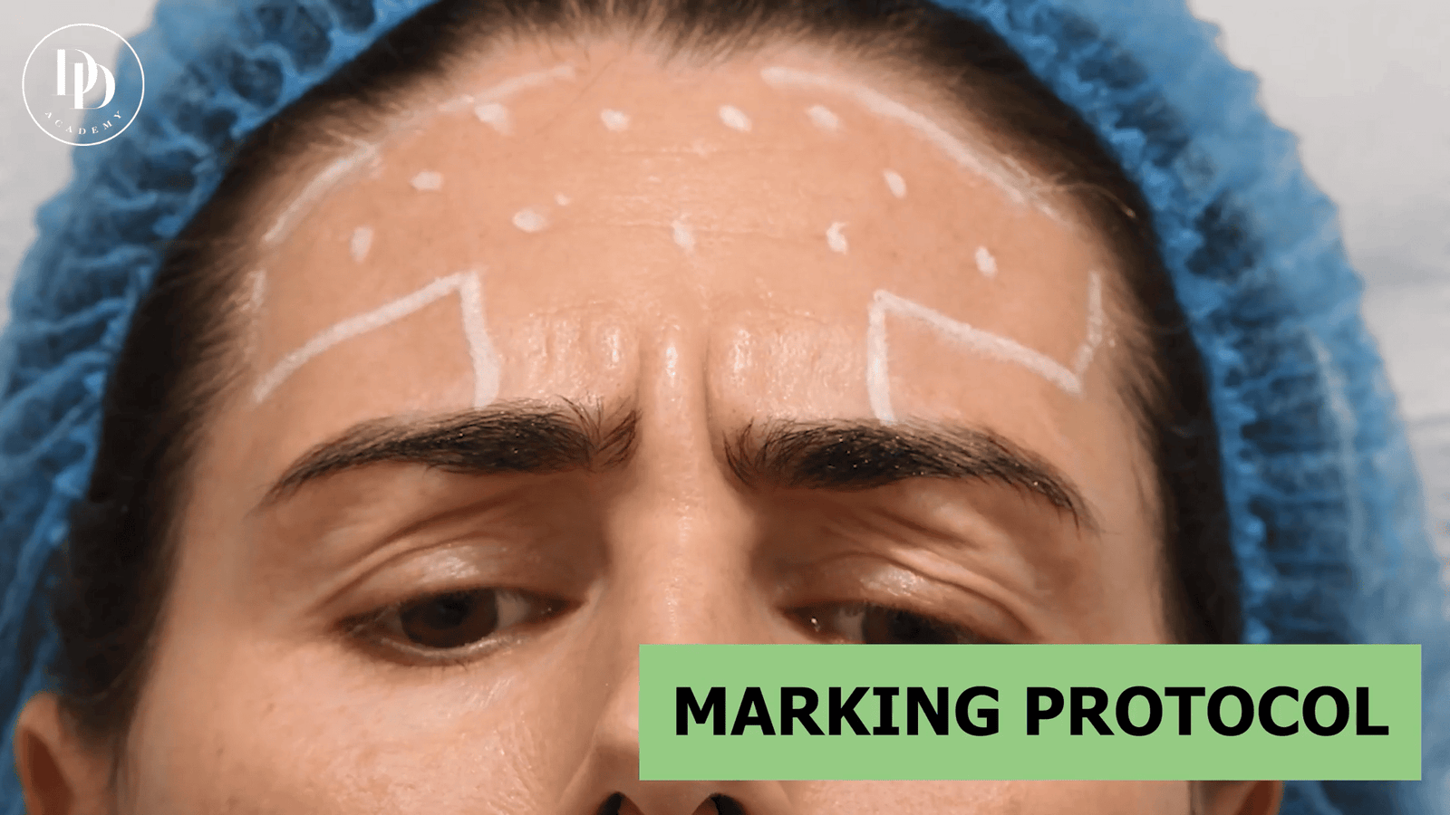 Facial muscle diagram illustrating corrugator and procerus contraction causing glabellar lines