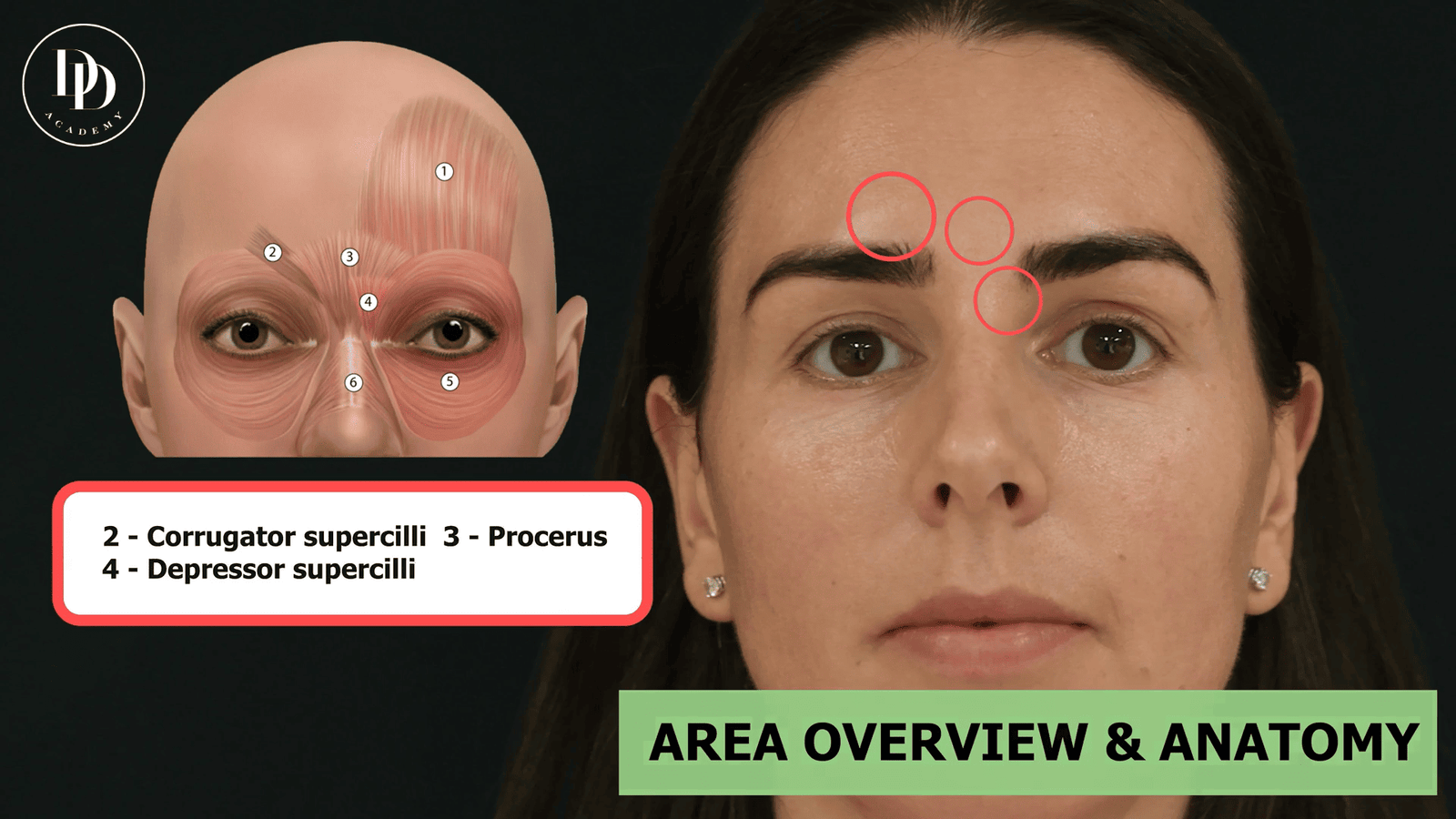Glabellar lines anatomy showing corrugator supercilii and procerus muscles involved in frown lines