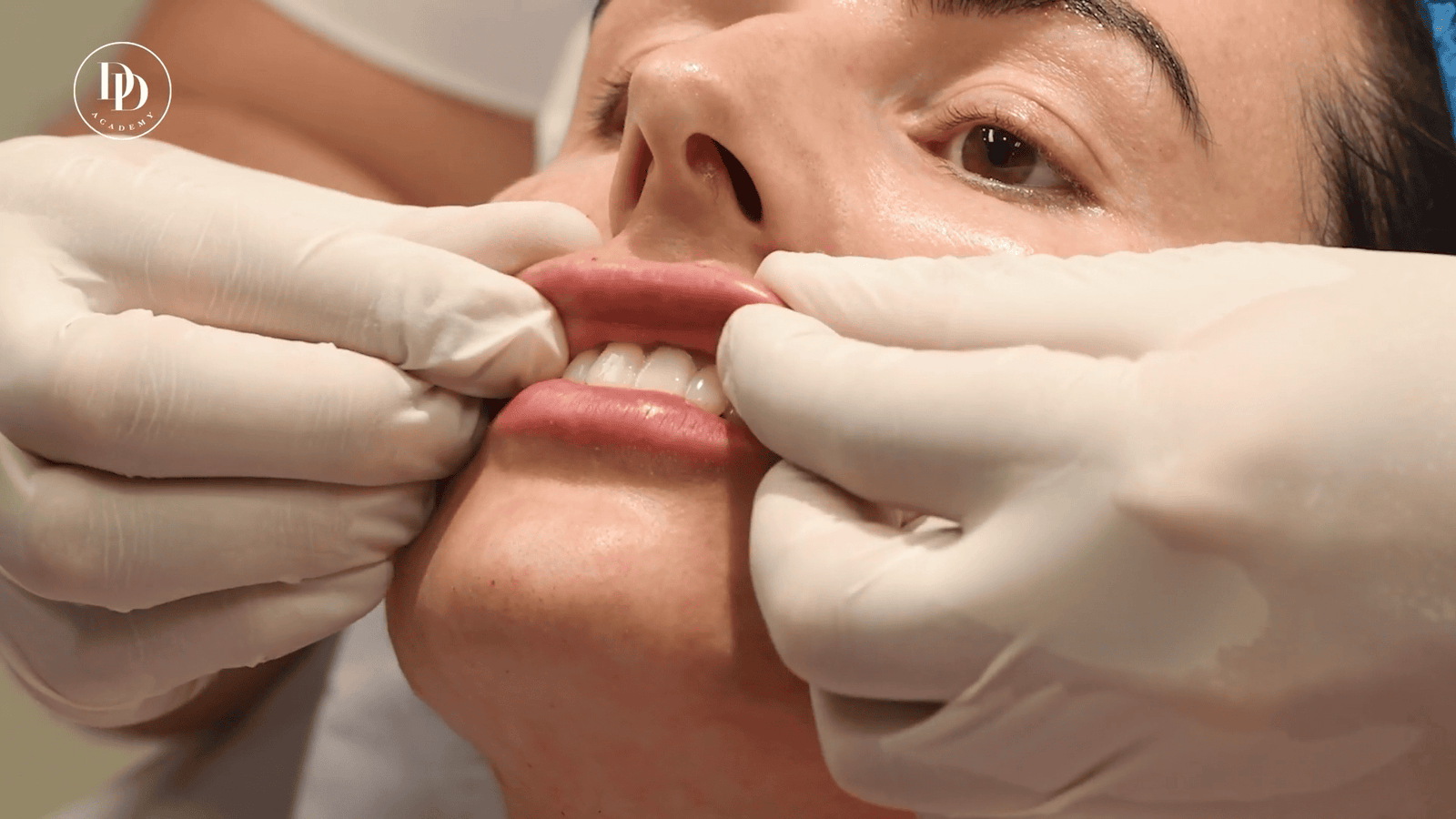 aesthetic practitioner assessing lip filler lumps before massage treatment