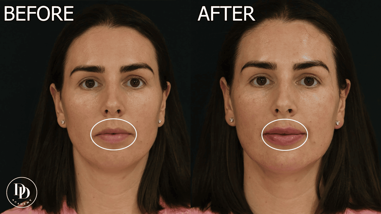 stages of swelling and healing after hyaluronic acid lip filler injections