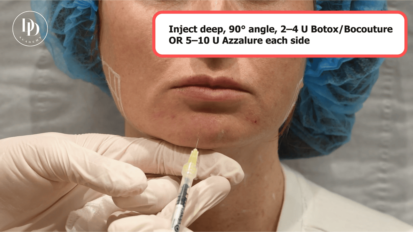 lower face anatomy mentalis depressor labii inferioris botox guide