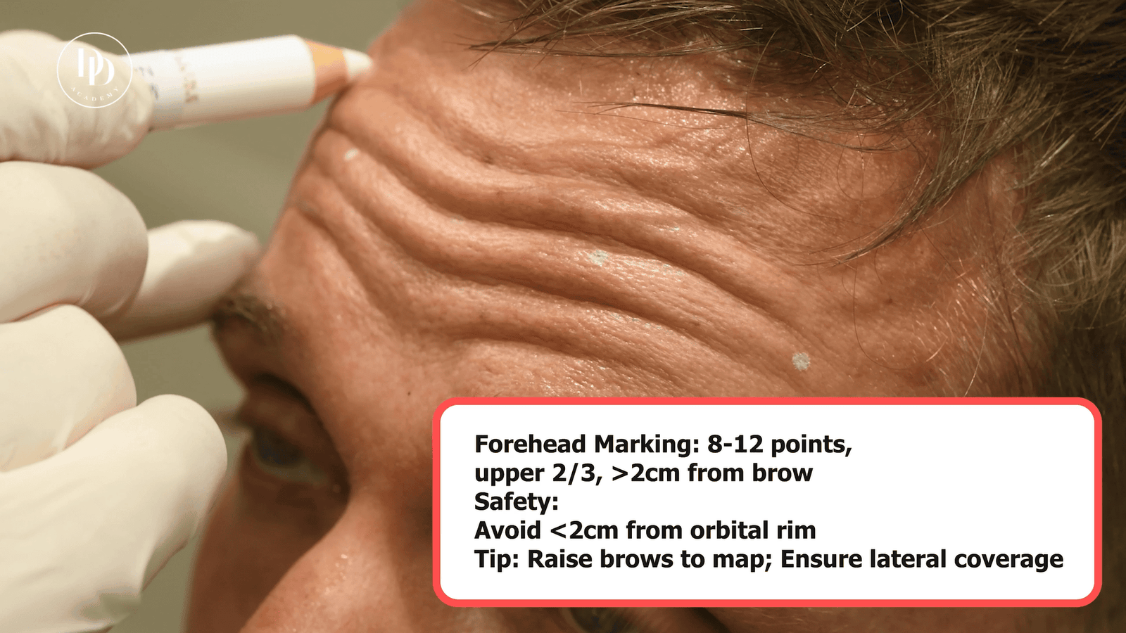 male botox injection sites clinical anatomy diagram