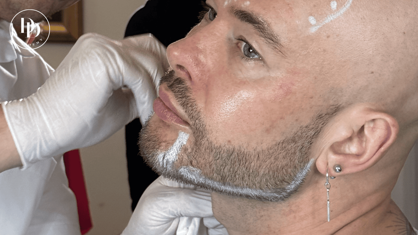 Male lower face Botox jawline treatment