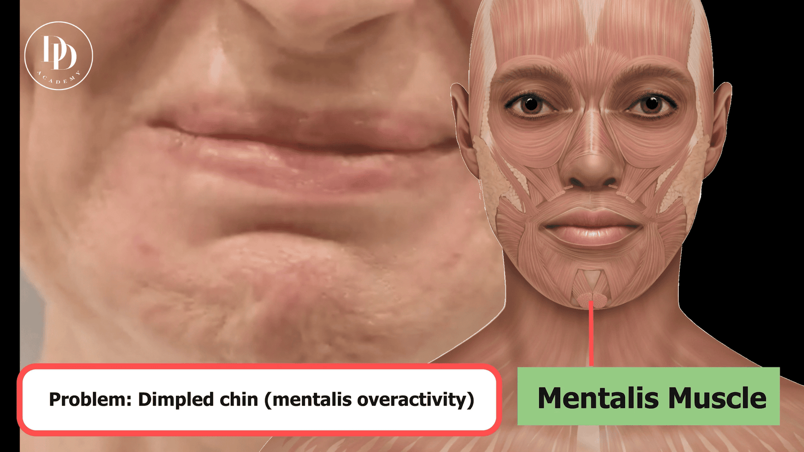 mentalis muscle anatomy chin botox treatment lower face