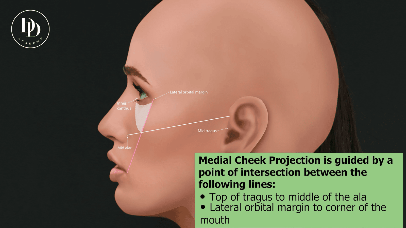 Facial anatomical landmarks used for cheek filler marking including zygomatic arch and malar apex