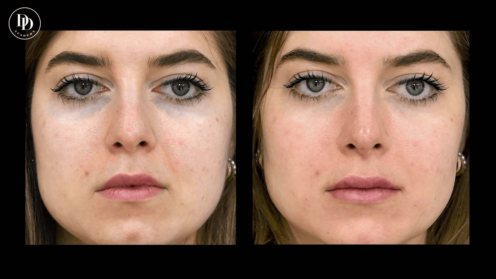 nasolabial lines filler before and after aesthetic treatment results