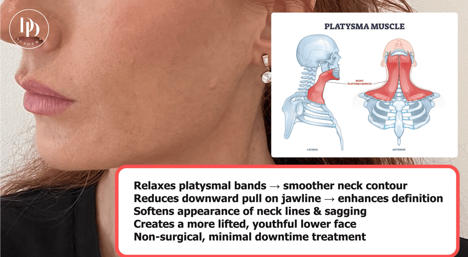 Neck botox injection anatomy showing platysma muscle and safety zones for aesthetic practitioners