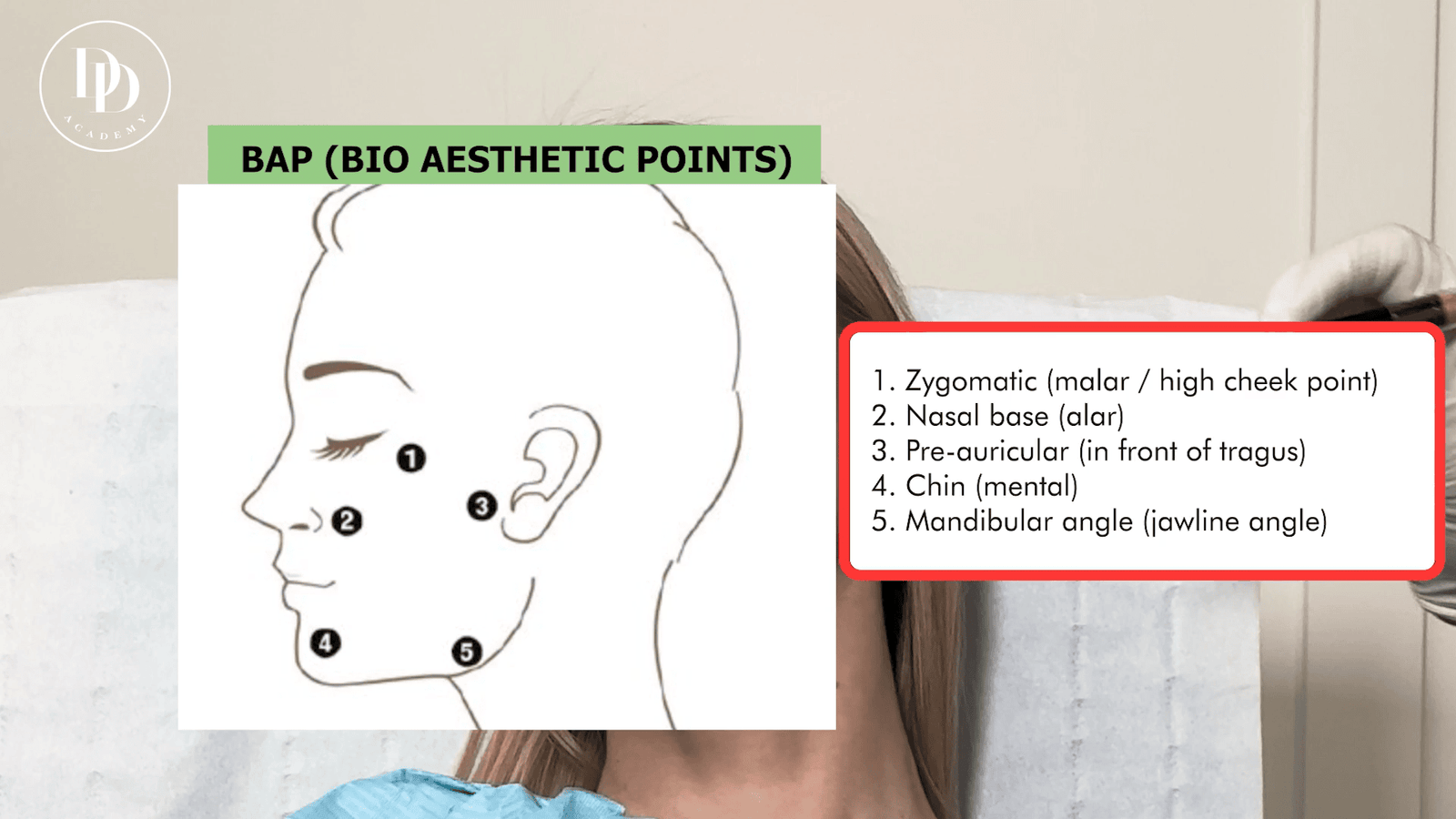 Profhilo injection points on the face showing Bio Aesthetic Points (BAP) and superficial subcutaneous injection plane mapping