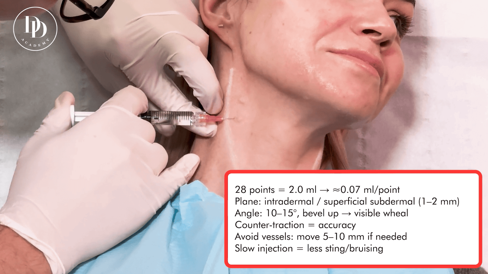Neck Profhilo injection mapping showing superficial dermal technique for bio remodelling and hydration
