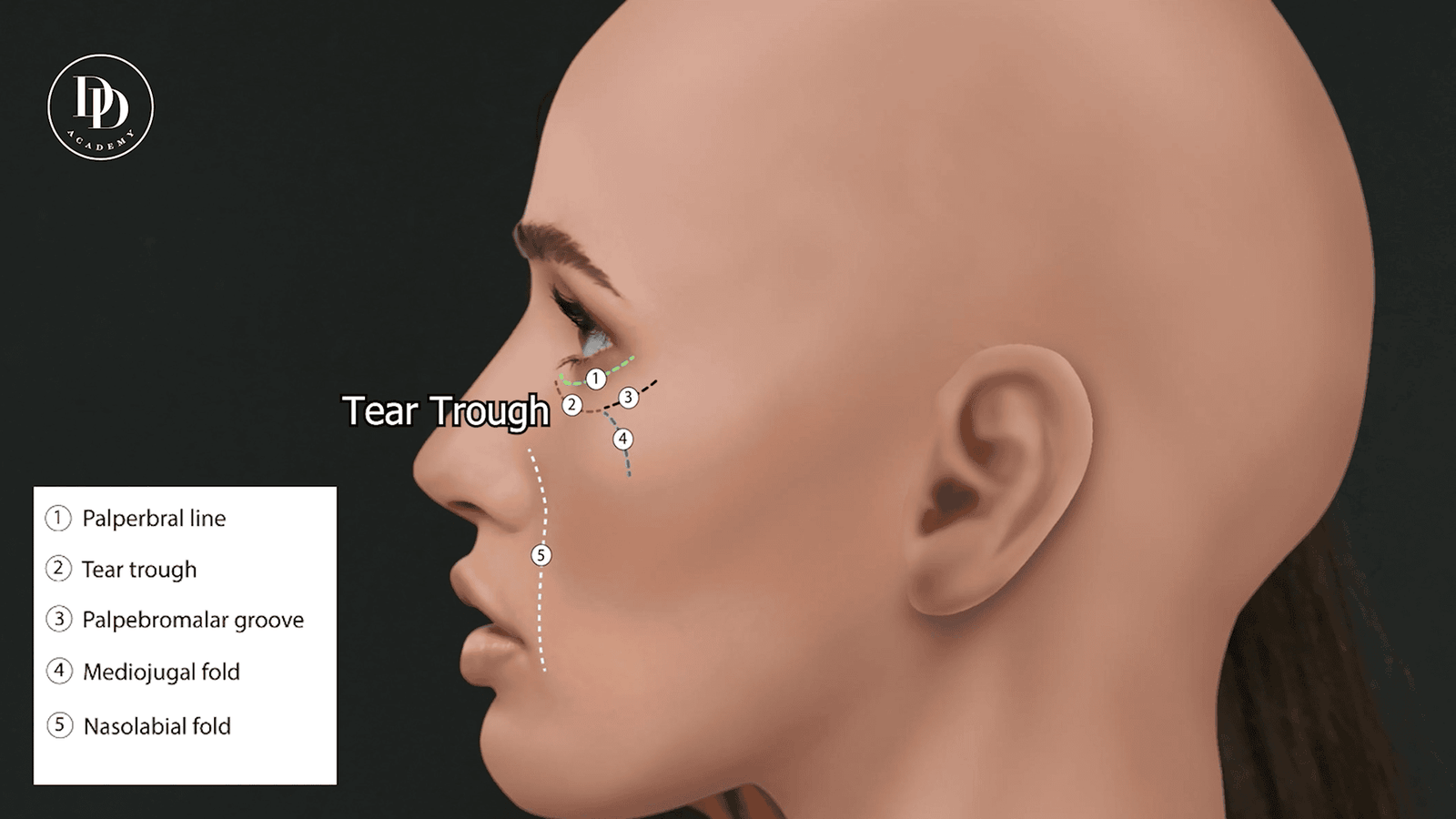 Tear trough anatomy showing ligament structures and infraorbital injection zones for dermal filler placement