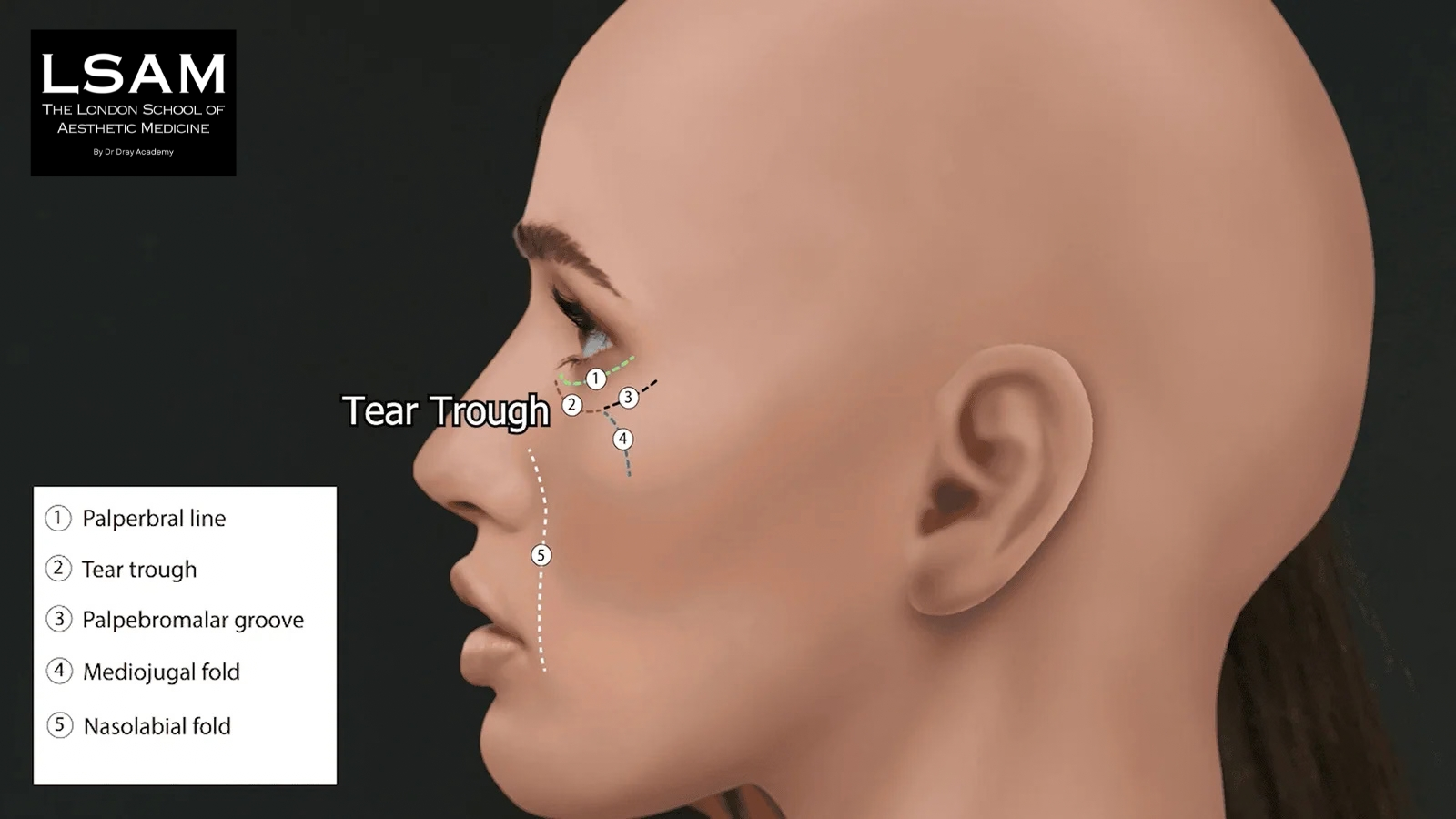 Tear trough anatomy showing ligament structures and infraorbital injection zones for dermal filler placement