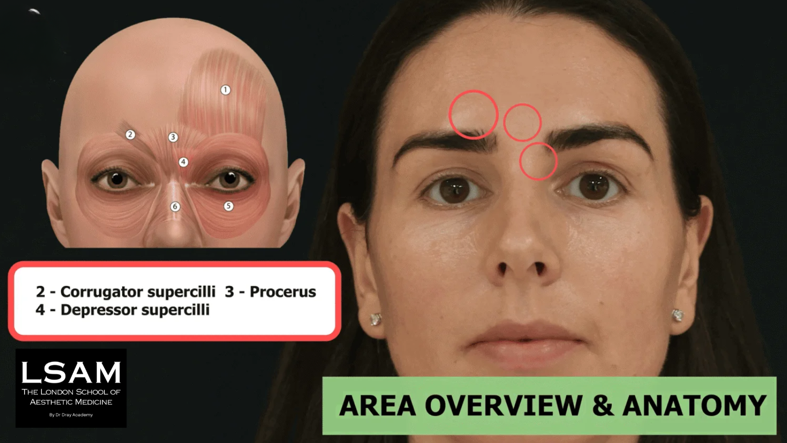 Glabellar lines anatomy showing corrugator supercilii and procerus muscles involved in frown lines