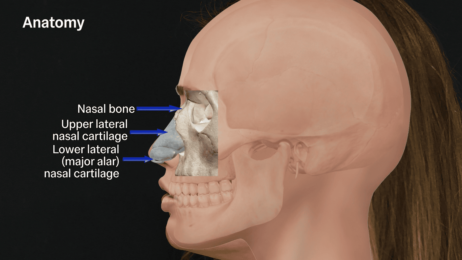 nasal anatomy injection zones for non-surgical rhinoplasty
